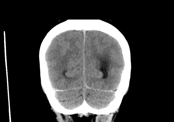 File:Obstructive hydrocephalus (Radiopaedia 30453-31119 Coronal non-contrast 33).jpg