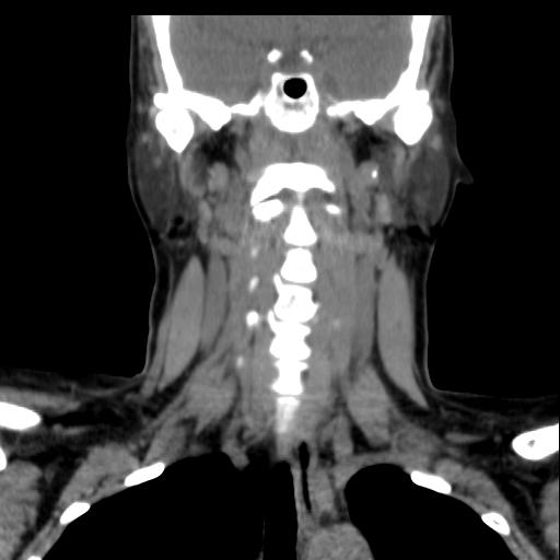 File:Obstructive sleep apnea (CT evaluation) (Radiopaedia 24304-24582 Coronal non-contrast 57).jpg
