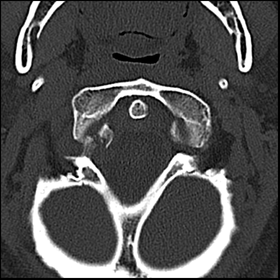 Occipital condyle fracture (type 1) (Radiopaedia 87670-104084 Axial bone window 14).jpg