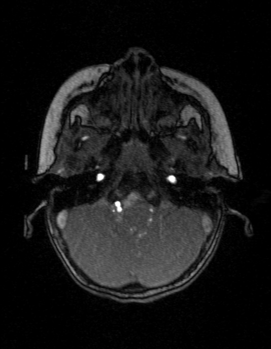 Occipital horn syndrome (Radiopaedia 14255-14129 MRA 27).jpg