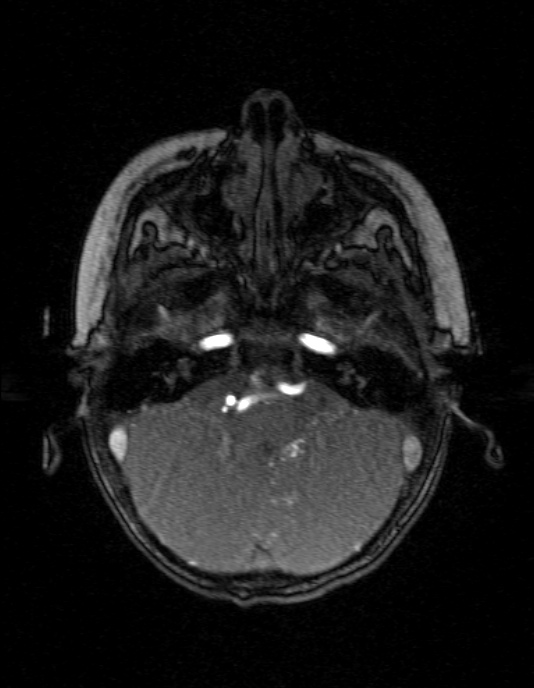 Occipital horn syndrome (Radiopaedia 14255-14129 MRA 32).jpg