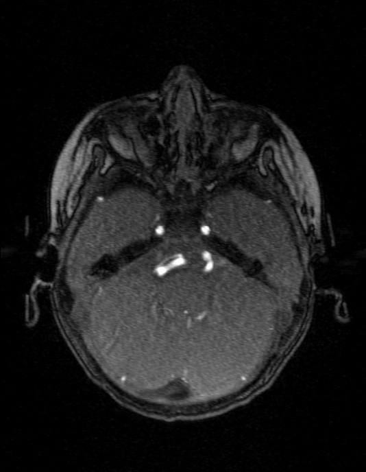 Occipital horn syndrome (Radiopaedia 14255-14129 MRA 39).jpg