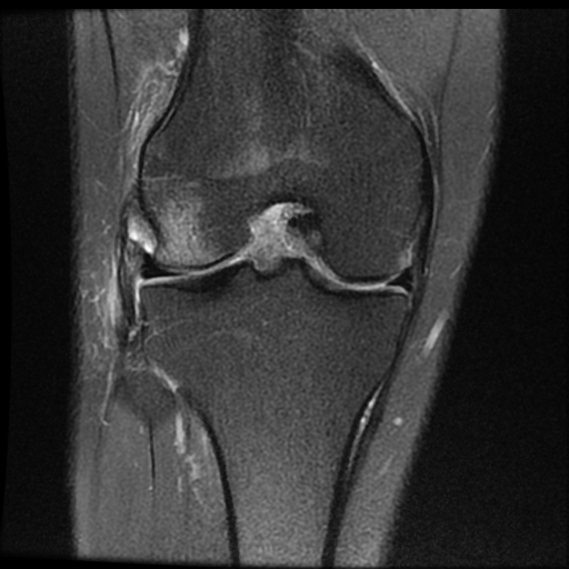 File:ACL acute full thickness tear - deep lateral femoral sulcus sign (Radiopaedia 38594-40740 Coronal PD fat sat 12).jpg