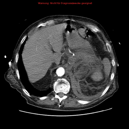 Abdominal aortic aneurysm- extremely large, ruptured (Radiopaedia 19882-19921 Axial C+ arterial phase 13).jpg