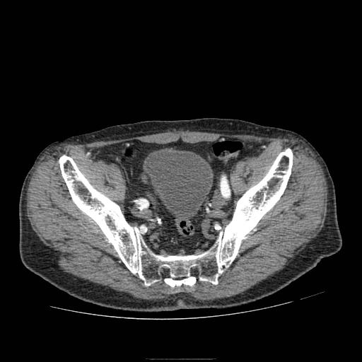 Abdominal aortic aneurysm (Radiopaedia 13341-13340 Axial C+ arterial phase 211).jpg
