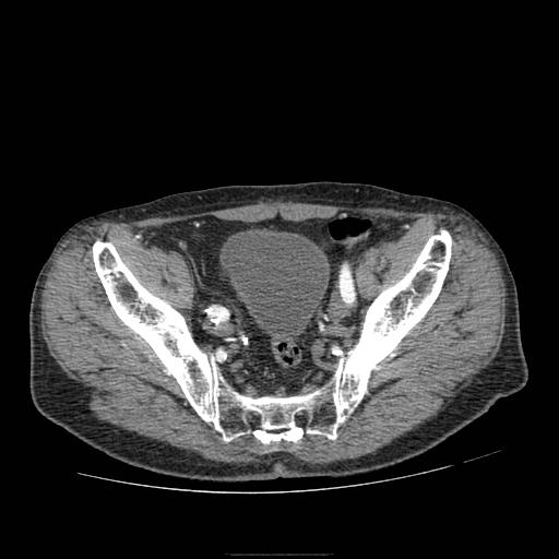Abdominal aortic aneurysm (Radiopaedia 13341-13340 Axial C+ arterial phase 212).jpg