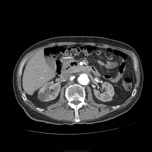 Abdominal aortic aneurysm (Radiopaedia 13341-13340 Axial C+ arterial phase 76).jpg