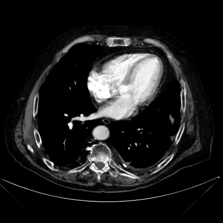 Abdominal aortic aneurysm (Radiopaedia 25855-26001 Axial C+ arterial phase 8).jpg