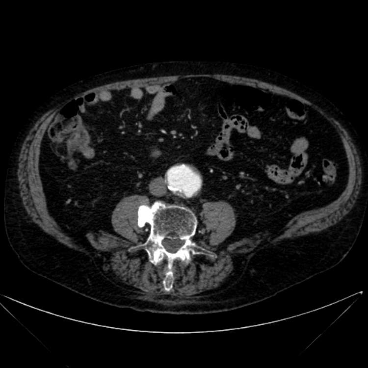 Abdominal aortic aneurysm (Radiopaedia 25855-26001 Axial C+ arterial phase 81).jpg