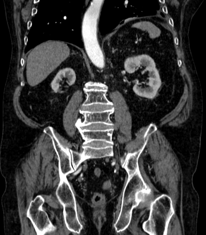 Abdominal aortic aneurysm (Radiopaedia 25855-26001 Coronal C+ arterial phase 49).jpg
