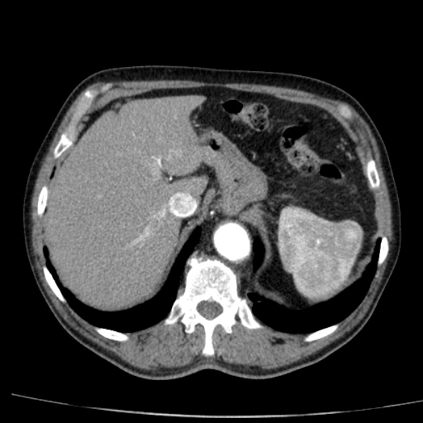Abdominal aortic aneurysm (Radiopaedia 29248-29660 Axial C+ arterial phase 15).jpg