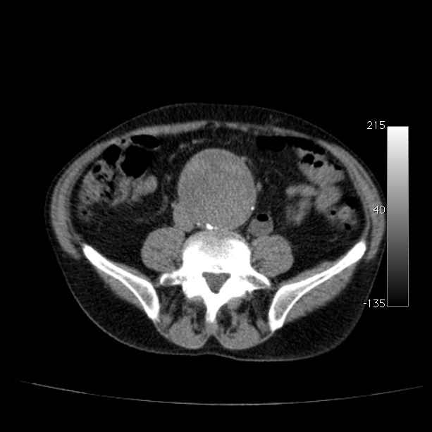 Abdominal aortic aneurysm (Radiopaedia 29248-29660 Axial non-contrast 36).jpg