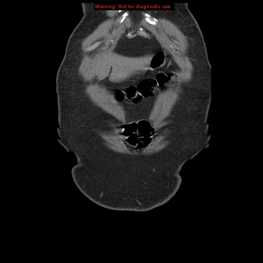 Abdominal aortic aneurysm (Radiopaedia 8190-9038 Coronal C+ arterial phase 10).jpg