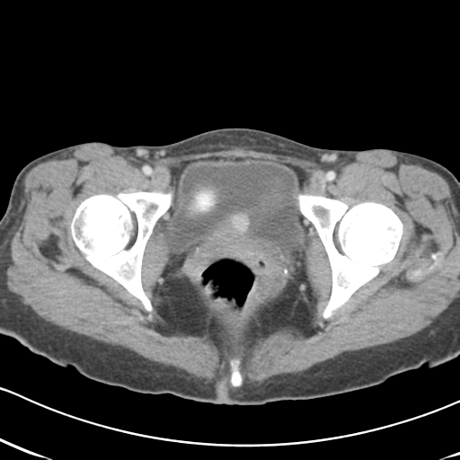 Abdominal desmoid tumor (Radiopaedia 41007-43740 Axial C+ portal venous phase 69).png