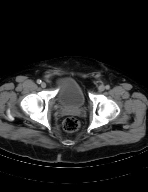 Abdominal lymphoma - with sandwich sign (Radiopaedia 53486-59492 Axial C+ portal venous phase 48).jpg
