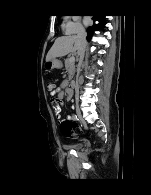 Abdominal lymphoma - with sandwich sign (Radiopaedia 53486-59492 Sagittal C+ portal venous phase 45).jpg