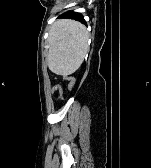 File:Abdominal lymphoma with sandwich sign (Radiopaedia 84378-99704 Sagittal C+ portal venous phase 84).jpg