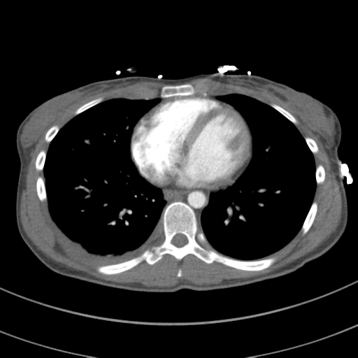 File:Abdominal multi-trauma - devascularised kidney and liver, spleen and pancreatic lacerations (Radiopaedia 34984-36486 Axial C+ arterial phase 56).png