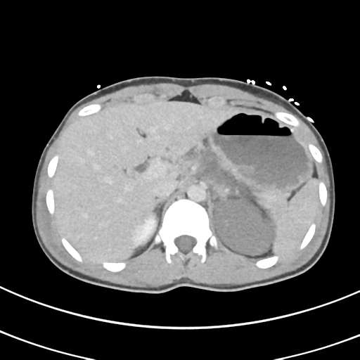 File:Abdominal multi-trauma - devascularised kidney and liver, spleen and pancreatic lacerations (Radiopaedia 34984-36486 Axial C+ delayed 18).png
