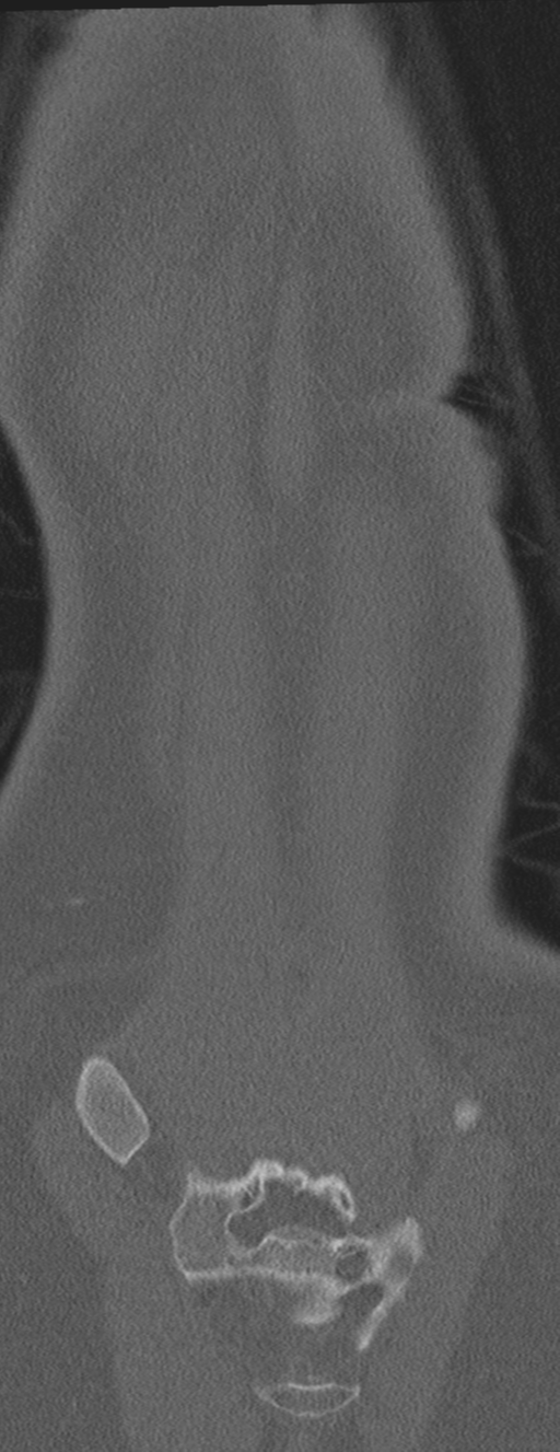 Abdominal multi-trauma - devascularised kidney and liver, spleen and pancreatic lacerations (Radiopaedia 34984-36486 Coronal bone window 68).png
