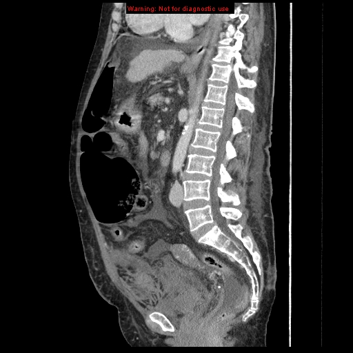 Abdominal wall hematoma (Radiopaedia 9427-10112 Sagittal C+ portal venous phase 51).jpg