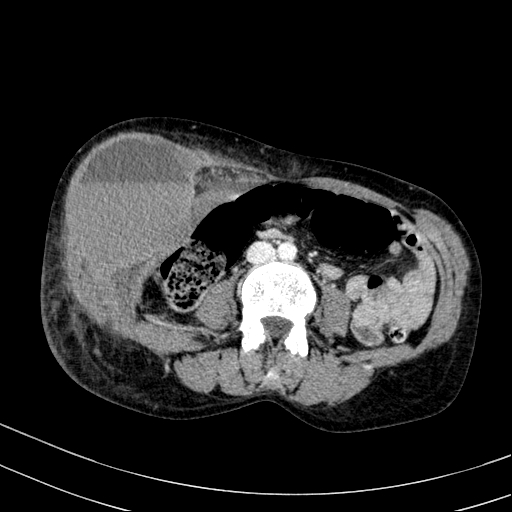 Abdominal wall hematoma with active bleeding (Radiopaedia 83915-99117 Axial C+ portal venous phase 56).jpg