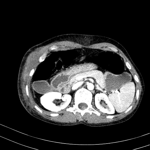 Abdominal wall hematoma with active bleeding (Radiopaedia 83915-99117 Axial renal cortical phase 11).jpg