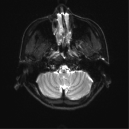 Abducens nerve palsy (Radiopaedia 51069-56648 Axial DWI 3).png
