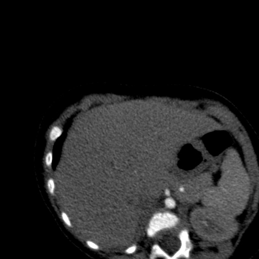 Aberrant left pulmonary artery (pulmonary sling) (Radiopaedia 42323-45435 Axial C+ CTPA 48).jpg