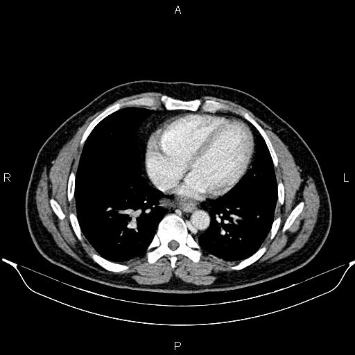 File:Aberrant right subclavian artery (Radiopaedia 87093-103354 Axial With contrast 74).jpg