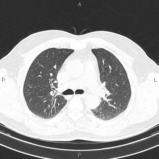 File:Aberrant right subclavian artery (Radiopaedia 87093-103354 Axial lung window 43).jpg