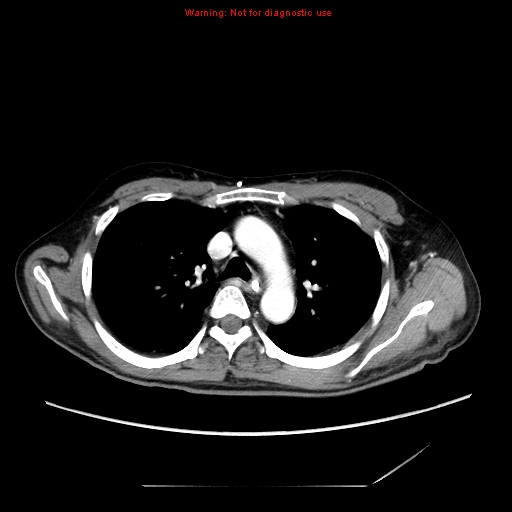 Aberrant right subclavian artery (Radiopaedia 9379-10071 Axial C+ arterial phase 23).jpg