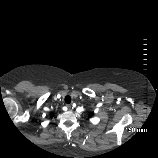 Aberrant right subclavian artery stenosis (Radiopaedia 52656-58670 Axial C+ arterial phase 7).jpg