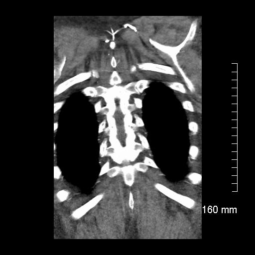 Aberrant right subclavian artery stenosis (Radiopaedia 52656-58670 B 74).jpg
