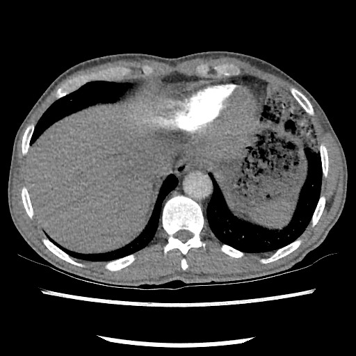 Accessory left horizontal fissure with lingular pneumonia (Radiopaedia 53763-59843 Axial C+ CTPA 76).jpg