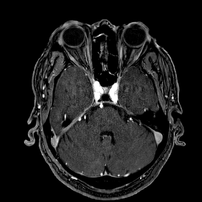 Accessory middle cerebral artery (Radiopaedia 73114-83828 Axial MRA 48).jpg