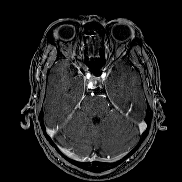 Accessory middle cerebral artery (Radiopaedia 73114-83828 Axial MRA 56).jpg