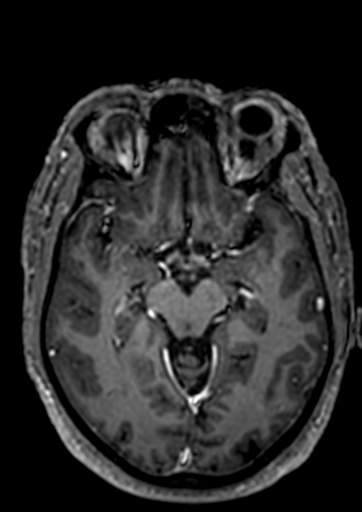 Accessory middle cerebral artery (Radiopaedia 73114-83828 Axial T1 C+ 65).jpg