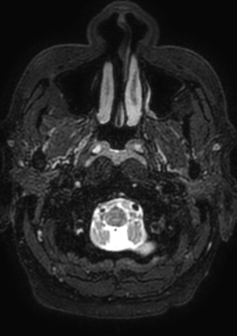 Accessory middle cerebral artery (Radiopaedia 73114-83828 Axial T2 221).jpg