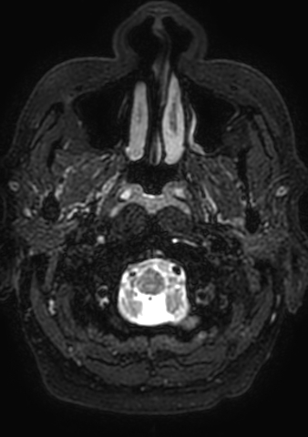 File:Accessory middle cerebral artery (Radiopaedia 73114-83828 Axial T2 222).jpg