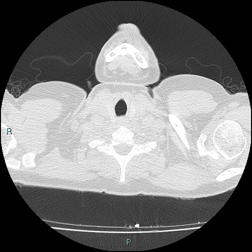 File:Accidental foreign body aspiration (seamstress needle) (Radiopaedia 77740-89983 Axial lung window 2).jpg