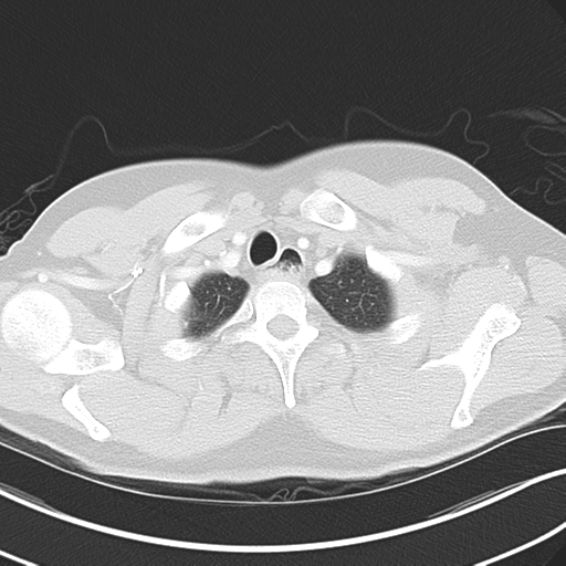 Achalasia of the cardia (Radiopaedia 38497-40595 Axial lung window 7).png