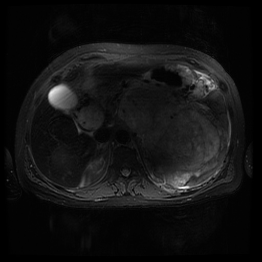 Acinar cell carcinoma of the pancreas (Radiopaedia 75442-86668 Axial T2 fat sat 28).jpg