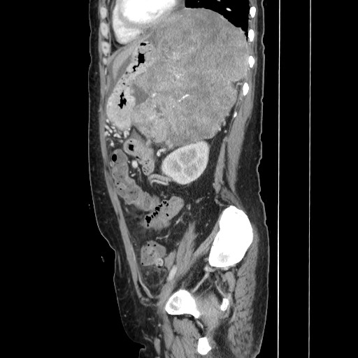 Acinar cell carcinoma of the pancreas (Radiopaedia 75442-86669 Sagittal C+ portal venous phase 131).jpg