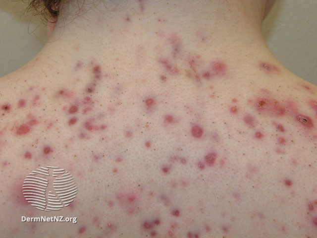 File:Acne affecting the back images (DermNet NZ acne-acne-back-144).jpg