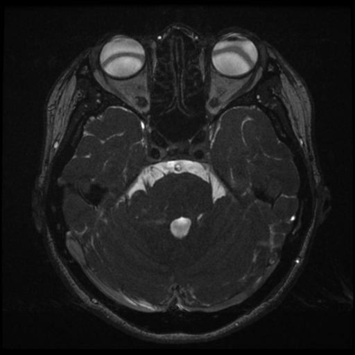 File:Acoustic neuroma (Radiopaedia 34049-35283 Axial 71).png