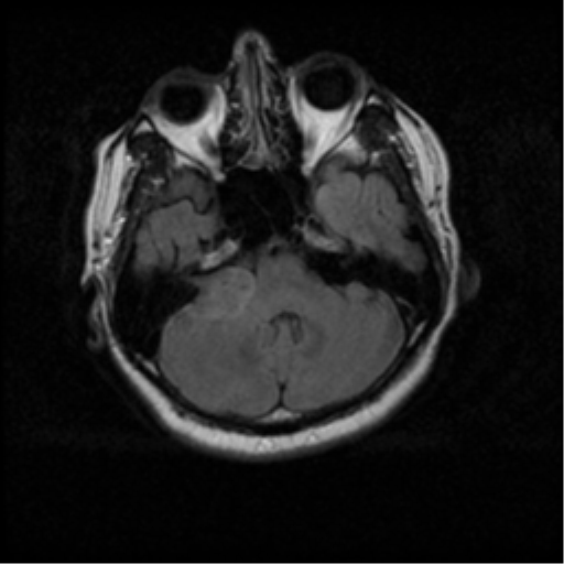 File:Acoustic schwannoma (Radiopaedia 33045-34060 Axial FLAIR 5).png