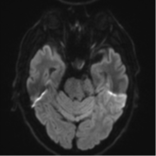 Acoustic schwannoma (Radiopaedia 55729-62281 E 35).png