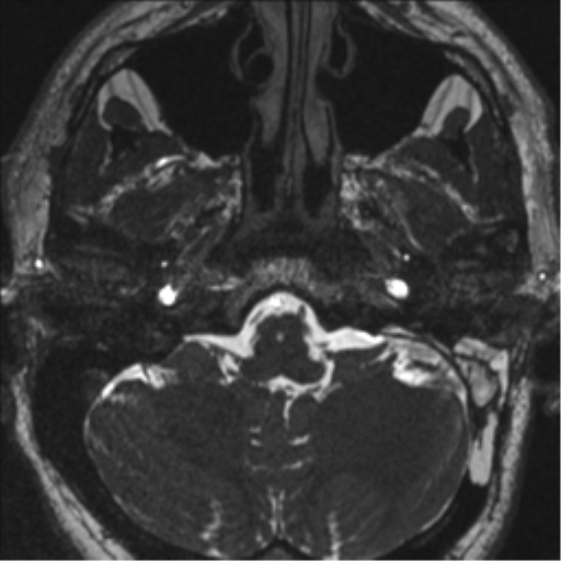 Acoustic schwannoma (translabyrinthine resection) (Radiopaedia 43570-46972 Axial CISS 16).png