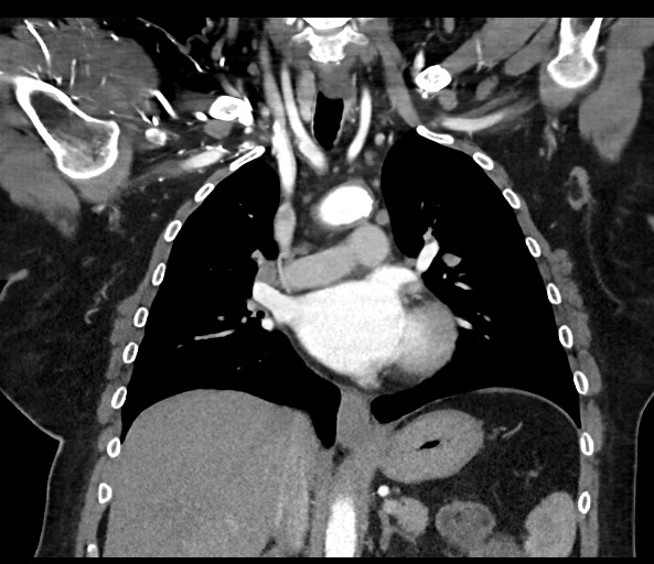Acromioclavicular joint cyst (Radiopaedia 58455-65610 Coronal C+ arterial phase 77).jpg